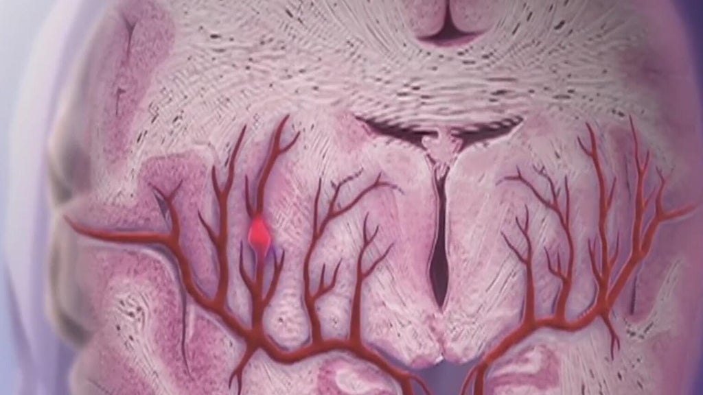 Knowing the signs of a stroke can save lives — Gainesville Community news